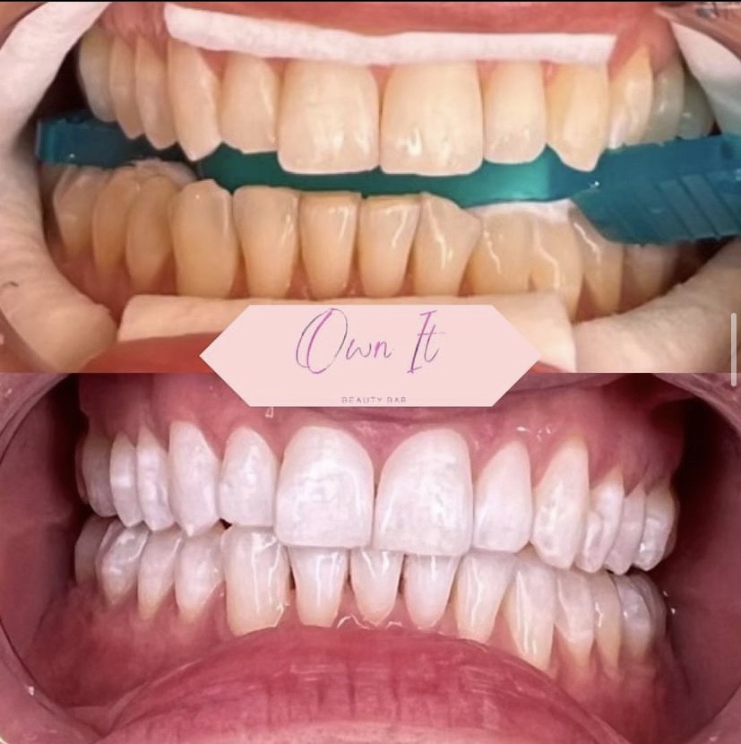 In Person Teeth Whitening & Tooth Gem Training Bundle (1-Day)